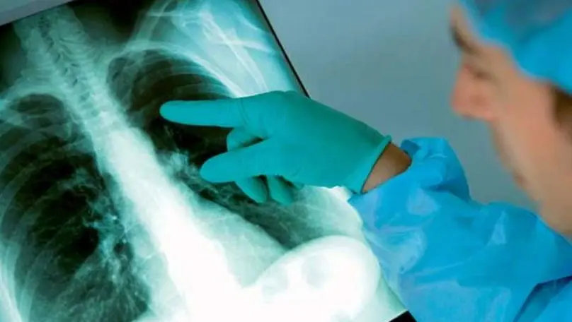 Focar de tuberculoză în raionul Soroca. Câte cazuri de îmbolnăviri au fost depistate